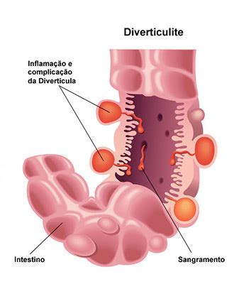 Diverticulite Aguda É Grave - Diverticulite Aguda - Grupo Surgical