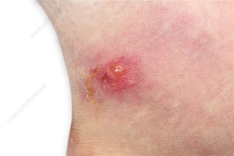 Cellulitis - Stock Image - C018/1008 - Science Photo Library