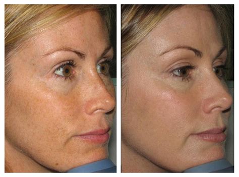 Ipl Laser Hair Removal Before And After - Property & Real Estate for Rent