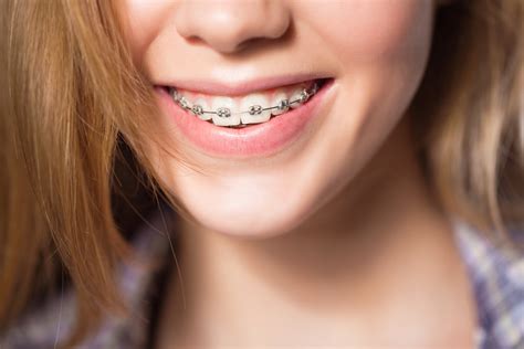 understanding   types  braces  smile dental