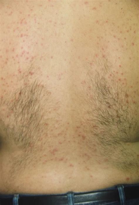 Miliaria - Dermatologic Disorders - MSD Manual Professional Edition