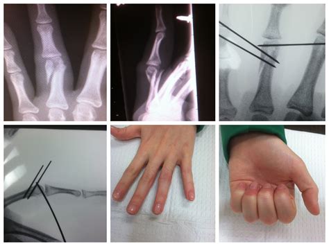 Why doctors are seeing more cases of thumb fasciculations now 20