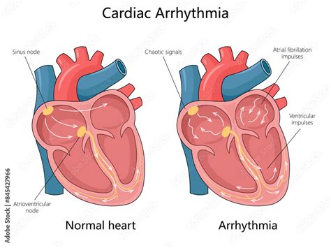 normal heart  cardiac arrhythmia showing sinus node chaotic