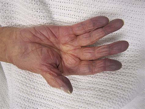 Sinica (objaw) – Wikipedia, wolna encyklopedia