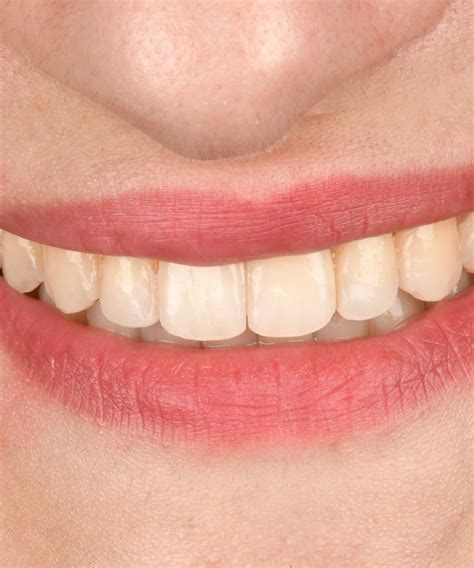 prothese dentaire fixe bridge en algerie naoufel dental center
