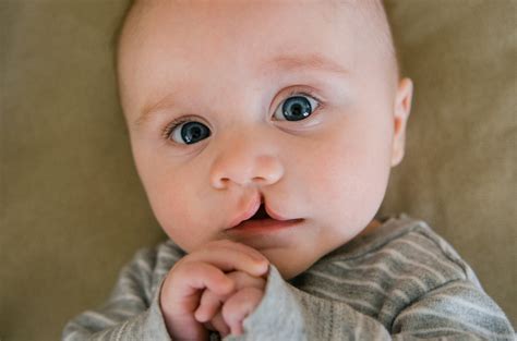 cleft palate institute  nw pa achievement center  lecom health