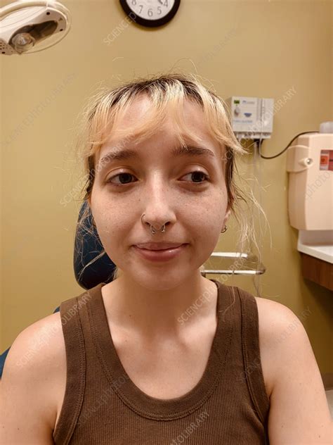 successful treatment  acne stock image  science photo