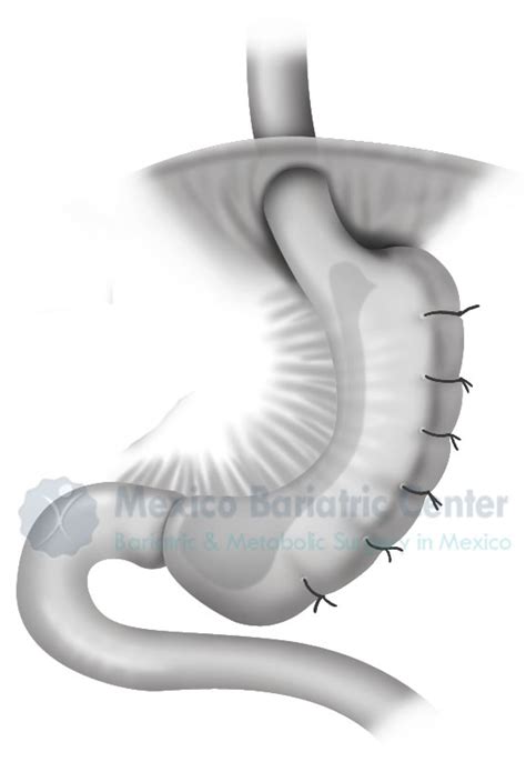gastric sleeve plication  mexico louisiana valenzuela md