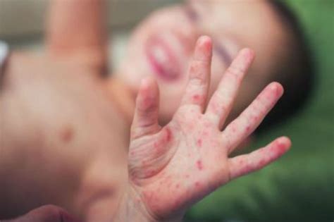 Phân biệt các dấu hiệu của bệnh sốt phát ban với bệnh sởi | Vinmec