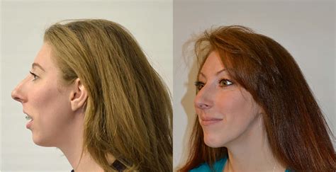 maxillary mandibular osteotomy salt lake city