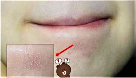 Tahukah Kenapa Ada Bintik-bintik Kecil Di Bawah Mulut Atau Dagu Seperti ...