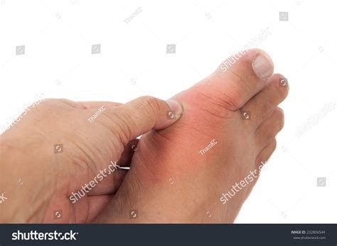painful gout inflammation  big toe stock photo  shutterstock