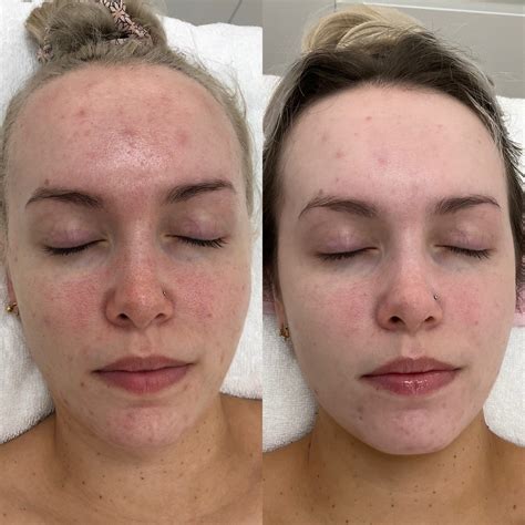 Transformations – Skin Love Clinic
