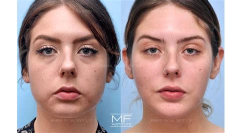 Radiesse Before and After Jowls Treatment - Medical SPA RX