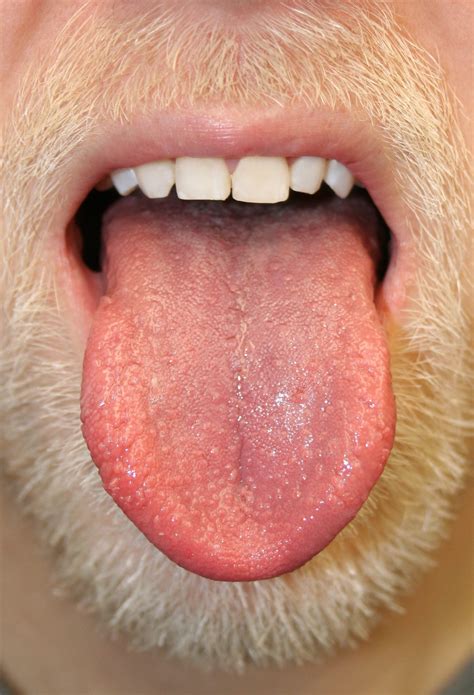 White Spots On The Back Of Your Tongue at Kimberly Potter blog