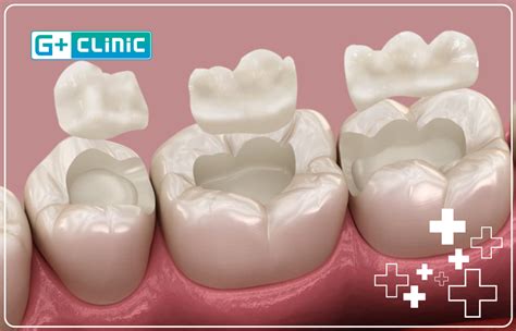 inlay  onlay fillings  turkey  clinic