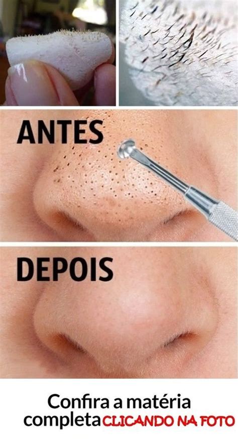 Video Tirando Cravos Do Rosto - Dicas Caseiras Para Eliminar Cravos do Rosto (Passo a Passo) | Receitas ...