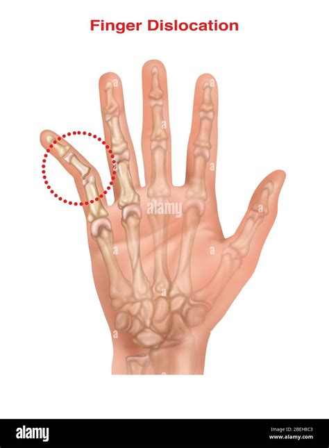 Dislocated pinky hi-res stock photography and images - Alamy