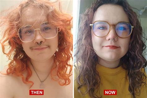 trans    transgender hair transplants treatment rooms