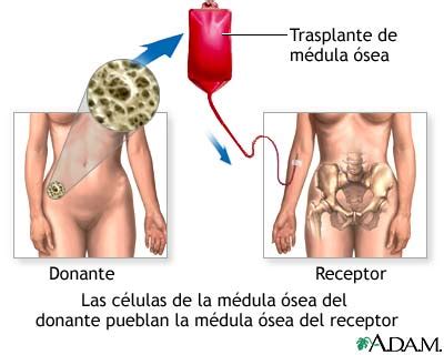 Trasplante de médula ósea | Innovaciones medicas.