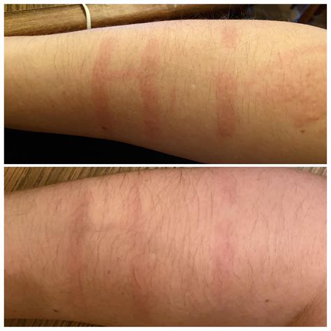 Update on cutting out alcohol (story in comments) : r/Dermatographia