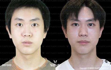 Eyelid Lift Before & After | Eyelid Specialists Los Angeles