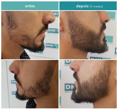 Implante De Barba Antes E Depois - Implante de barba a nova tendência de beleza masculina – Barbearia O ...