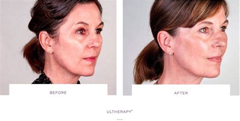 how to get rid of jowls