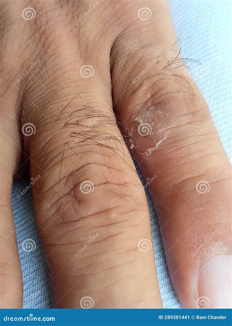 Ringworm Image. Skin Disease Photography. Skin Infection. Stock Image
