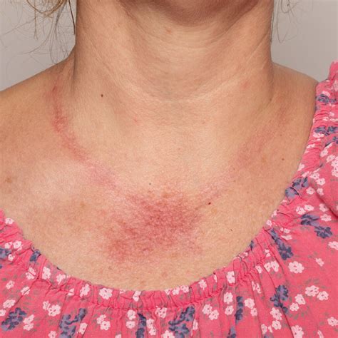 Alergia A Sulfato De Niquel - Alergia a níquel e bijuteria - Dra. Ana Luiza Villarinho
