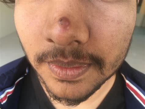 Ask a Dermatologist Online for Removing Of Wart