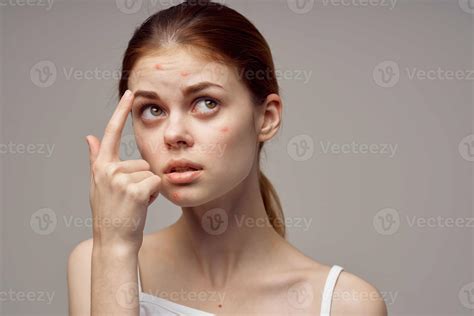 beautiful woman with pimples on the face hygiene isolated background