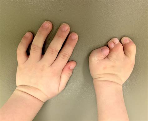 Cleft hand vs symbrachydactyly