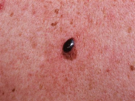 Types Of Melanoma Skin Cancer