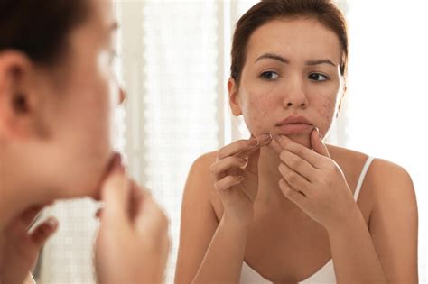 Acne Types, Treatments & How Gut Microbiome Affects Skin | Viome