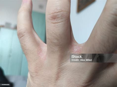 eczema  fingers skin irritation stock photo  image