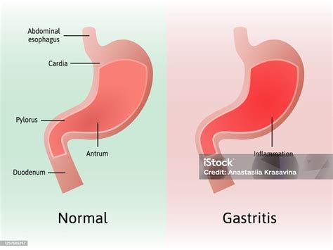 Fotos De Gastrite No Estômago - Vetores de Gastrite Inflamação Irritação Ou Erosão Do Revestimento Do ...