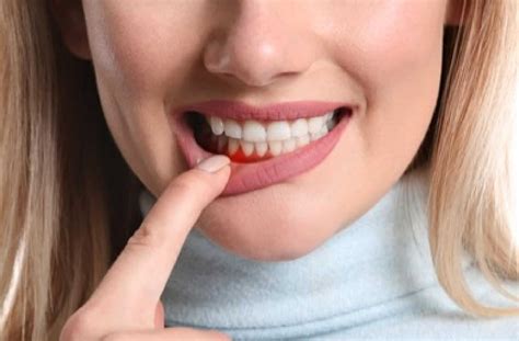 Is Gingivitis Reversible? | Ancaster
