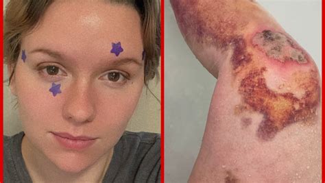 Fundraiser by Jaelyn Guillotte : Help Jaelyn: Road Accident Medical Bills