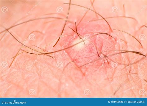 Close Up Photo of Nodular Cystic Acne Skin Stock Photo - Image of ...