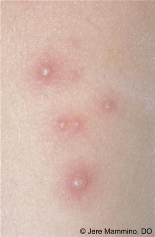 Chicken Pox Pictures In Adults