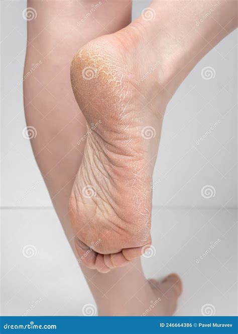Closeup of Dry Skin of Feet, Sole with Scales and Cracks. Moisturizer