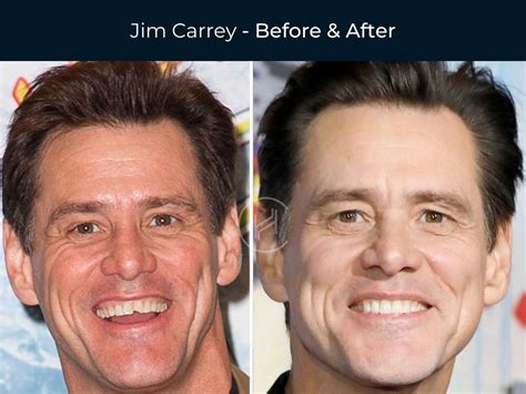 Black Celebrities With Bad Teeth Before And After - vrogue.co