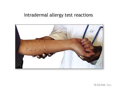 The New York Times > Health > Image > Intradermal Allergy Test Reactions