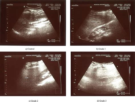 evaluation  biomarkers  egyptian patients   grades