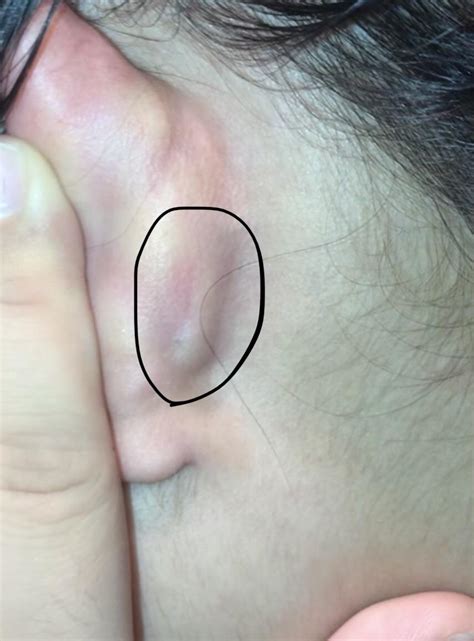 Swollen painful bump behind ear?? What could this be : r/DiagnoseMe