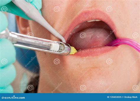 Dental Anesthesia Injection Royalty-Free Stock Image | CartoonDealer ...