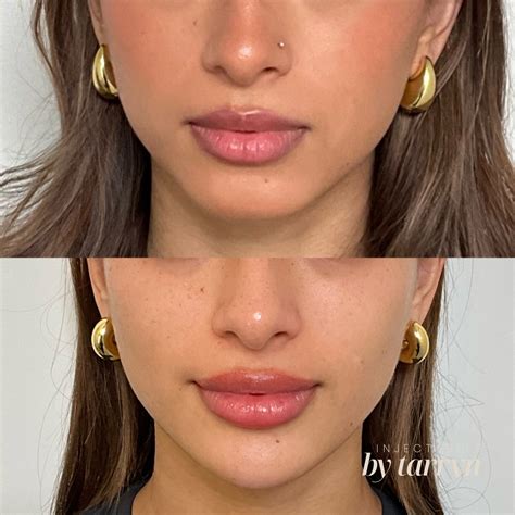 INJECTABLE NURSE NZ | Here’s why filler can sometimes make you look