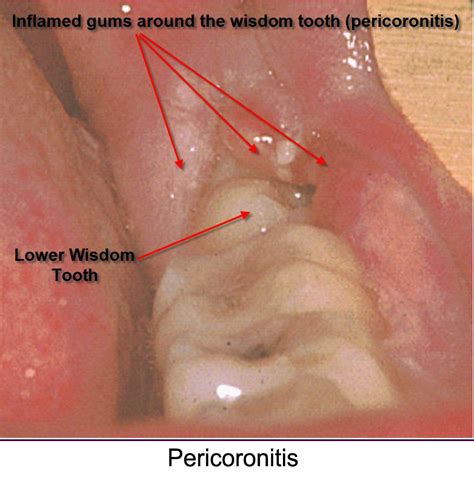 wisdom teeth removal  sinus drainage  shirley poe blog