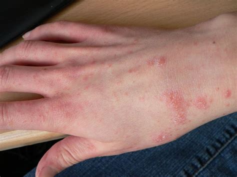 pictures  common skin rashes symptoms treatments gohealth urgent